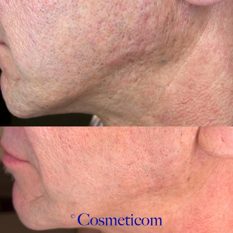 Exosomes Cocktail, 5 x 5 ml hætteglas, SkinClinic