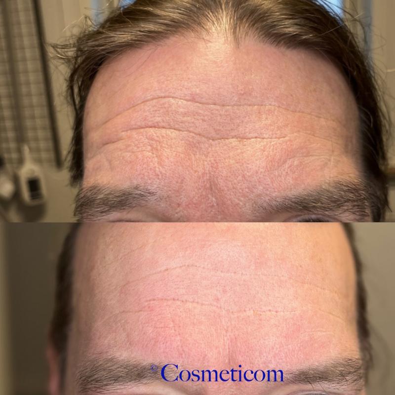 Exosomes Cocktail, 5 x 5 ml hætteglas, SkinClinic