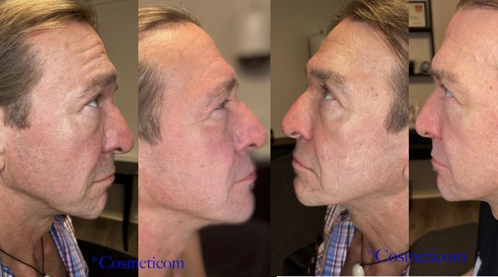 Exosomes Cocktail, 5 x 5 ml hætteglas, SkinClinic