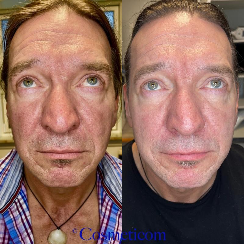 Exosomes Cocktail, 5 x 5 ml hætteglas, SkinClinic